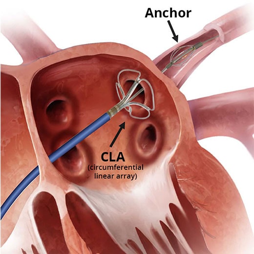 catheter in situ Medical device